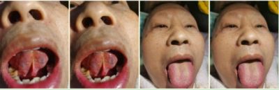 2024新春献礼专题报道 著名瑶医银疗推拿专家——周继辉