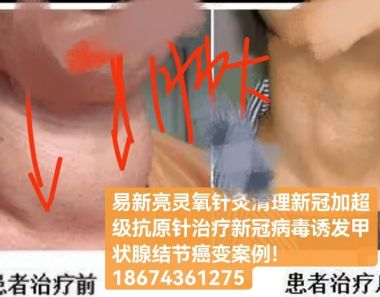 易新亮灵氧细胞针灸：开创百病断根快如闪电的创新疗法深度剖析！