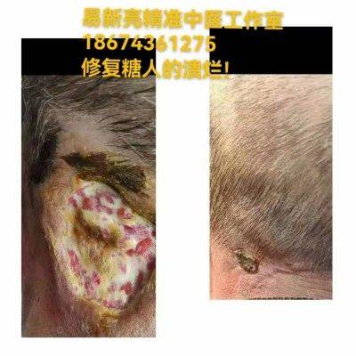 吃药打针降糖治不好糖尿病 易新亮灵氧细胞靶向针灸却能逆转三高断药