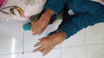 云南一中医独创“风湿骨病新诊疗法”:其“五大绝招”已治愈五千余患者